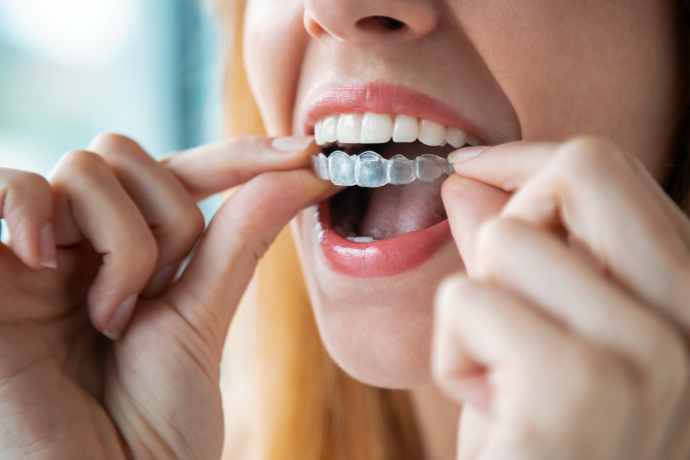woman wearing orthodontic silicone trainer